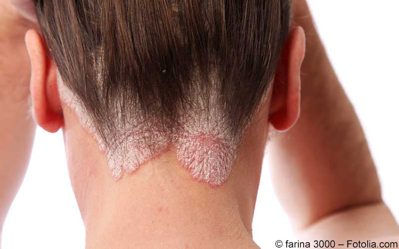 Acitretin und Teratogenität Acitretin und Teratogenität